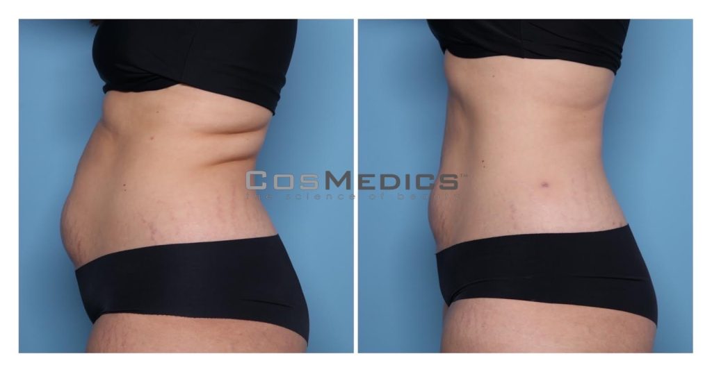 How EmSculpt NEO can help improve Diastasis Recti