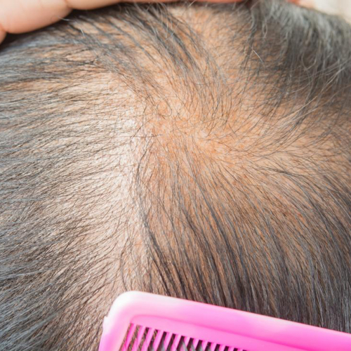 PRP (Platelet-Rich Plasma) for Thinning Hair